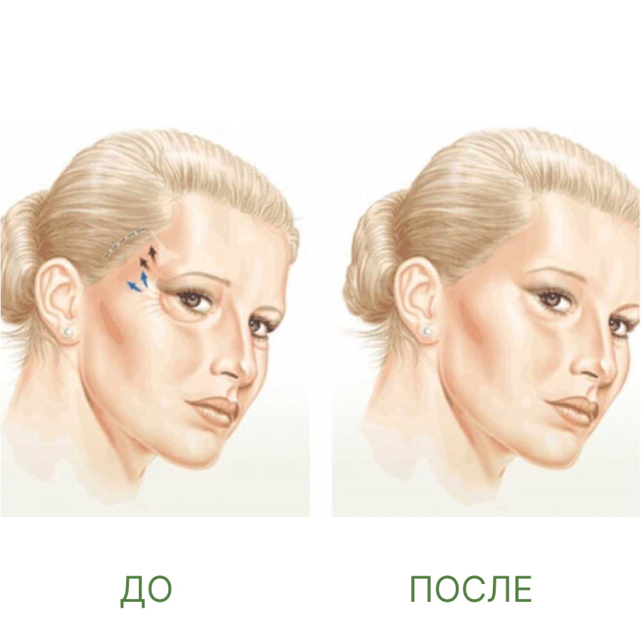 Височный лифтинг 